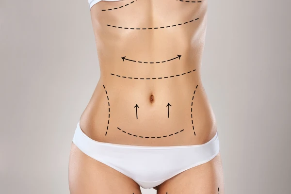 abdominoplastía en guadalajara mexico